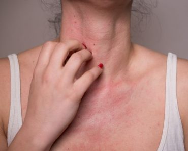 Mulher coçando sua pele em decorrência da alergia emocional