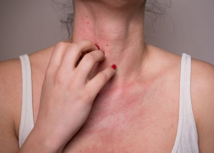 Mulher coçando sua pele em decorrência da alergia emocional